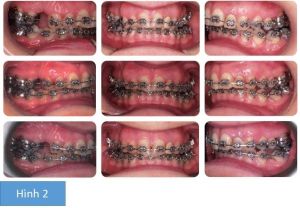 Phân tích case: Niềng răng, phẫu thuật hàm và phẫu thuật làm nhỏ cằm cho khách hàng nữ 42 tuổi