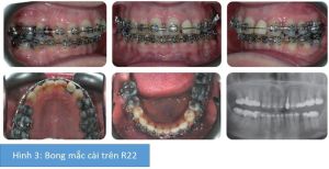 Phân tích case: Niềng răng, phẫu thuật hàm và phẫu thuật làm nhỏ cằm cho khách hàng nữ 42 tuổi