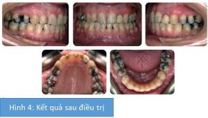 Phân tích case: Niềng răng, phẫu thuật hàm và phẫu thuật làm nhỏ cằm cho khách hàng nữ 42 tuổi