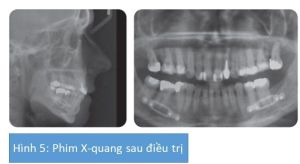 Phân tích case: Niềng răng, phẫu thuật hàm và phẫu thuật làm nhỏ cằm cho khách hàng nữ 42 tuổi