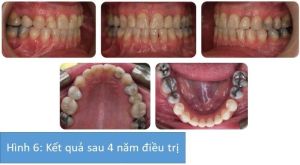 Phân tích case: Niềng răng, phẫu thuật hàm và phẫu thuật làm nhỏ cằm cho khách hàng nữ 42 tuổi