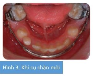 Phân tích case: Niềng răng thành công cho bệnh nhân 10 tuổi có các răng số 5 mọc ngầm và R21 chết tủy