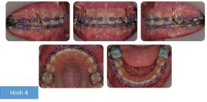 Phân tích case: Niềng răng thành công cho bệnh nhân 10 tuổi có các răng số 5 mọc ngầm và R21 chết tủy