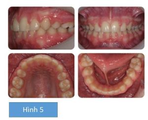 Phân tích case: Niềng răng thành công cho bệnh nhân 10 tuổi có các răng số 5 mọc ngầm và R21 chết tủy