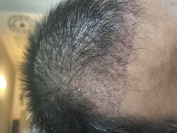 Cấy tóc được 4 tháng nhưng tóc không mọc cũng không rụng