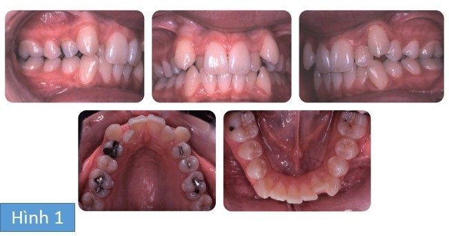 Phân tích case: Niềng răng thành công cho bệnh nhân có răng chen chúc, không thích hình dáng răng nanh của mình