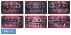 Phân tích case: Niềng răng thành công cho bệnh nhân có răng chen chúc, không thích hình dáng răng nanh của mình