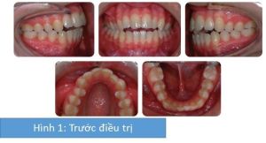 Phân tích case: Niềng răng thành công cho bệnh nhân cắn hở phía trước và cắn chéo răng sau một bên