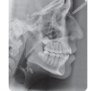 Phân tích case: Niềng răng thành công cho bệnh nhân cắn hở phía trước và cắn chéo răng sau một bên