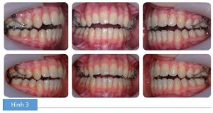 Phân tích case: Niềng răng thành công cho bệnh nhân cắn hở phía trước và cắn chéo răng sau một bên