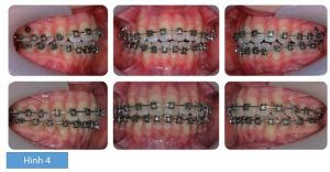 Phân tích case: Niềng răng thành công cho bệnh nhân cắn hở phía trước và cắn chéo răng sau một bên