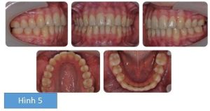 Phân tích case: Niềng răng thành công cho bệnh nhân cắn hở phía trước và cắn chéo răng sau một bên