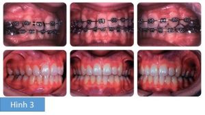 Phân tích case: Niềng răng thành công cho bệnh nhân có răng chen chúc, không thích hình dáng răng nanh của mình