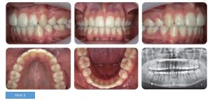 Phân tích case: Chỉnh nha ngụy trang cho bệnh nhân bị hô hàm, răng mọc chen chúc