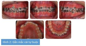 Phân tích case: Hình ảnh niềng răng mắc cài tự buộc của bệnh nhân có chen chúc nhẹ