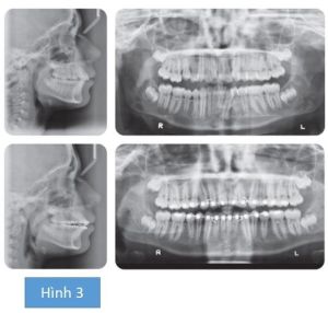 Phân tích case: Hình ảnh niềng răng mắc cài tự buộc của bệnh nhân có chen chúc nhẹ