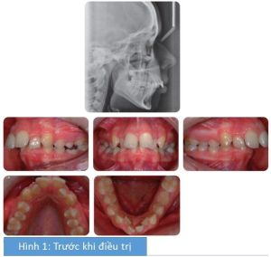Phân tích case: Chỉnh nha ngụy trang có nhổ răng cho bệnh nhân bị hô