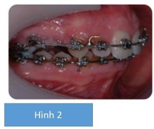 Phân tích case: Chỉnh nha ngụy trang có nhổ răng cho bệnh nhân bị hô