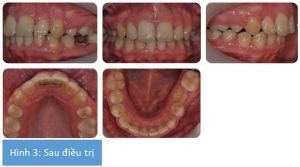 Phân tích case: Chỉnh nha ngụy trang có nhổ răng cho bệnh nhân bị hô
