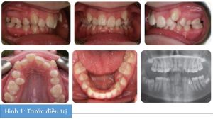 Phân tích case: Niềng răng thành công cho bệnh nhân nữ 14 tuổi bị hô