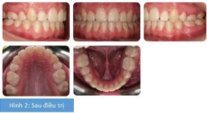 Phân tích case: Niềng răng thành công cho bệnh nhân nữ 14 tuổi bị hô