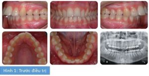Phân tích case: Niềng răng cho bệnh nhân 18 tuổi có sử dụng khí cụ neo chặn tạm thời (TADs)