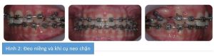 Phân tích case: Niềng răng cho bệnh nhân 18 tuổi có sử dụng khí cụ neo chặn tạm thời (TADs)