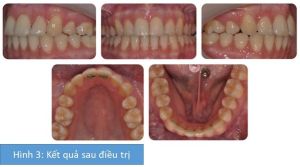 Phân tích case: Niềng răng cho bệnh nhân 18 tuổi có sử dụng khí cụ neo chặn tạm thời (TADs)