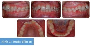Phân tích case: Chỉnh nha thành công cho bệnh nhân có răng cửa khấp khểnh, độ cắn chìa lớn