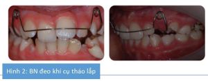 Phân tích case: Chỉnh nha thành công cho bệnh nhân có răng cửa khấp khểnh, độ cắn chìa lớn