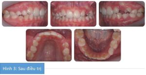 Phân tích case: Chỉnh nha thành công cho bệnh nhân có răng cửa khấp khểnh, độ cắn chìa lớn