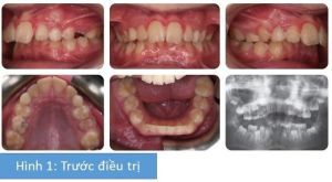 Phân tích case: Niềng răng không nhổ răng cho bệnh nhân có độ cắn chìa lớn, hàm dưới lùi xa