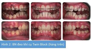 Phân tích case: Niềng răng không nhổ răng cho bệnh nhân có độ cắn chìa lớn, hàm dưới lùi xa