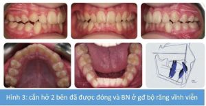 Phân tích case: Niềng răng không nhổ răng cho bệnh nhân có độ cắn chìa lớn, hàm dưới lùi xa