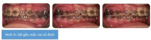 Phân tích case: Niềng răng không nhổ răng cho bệnh nhân có độ cắn chìa lớn, hàm dưới lùi xa