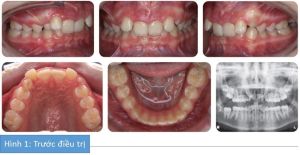 Phân tích case: Niềng răng thành công cho bệnh nhân có khớp cắn sâu phức tạp