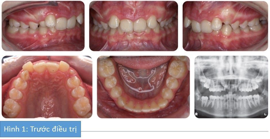 Phân tích case: Niềng răng thành công cho bệnh nhân có khớp cắn sâu phức tạp