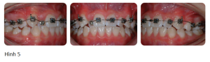 Phân tích case: Niềng răng thành công cho bệnh nhân bị móm có sử dụng headgear kéo trước