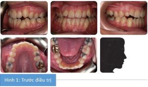 Phân tích case: Niềng răng thành công cho bệnh nhân nữ 22 tuổi than phiền về vẻ ngoài các răng trước