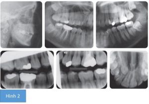 Phân tích case: Niềng răng thành công cho bệnh nhân nữ 22 tuổi than phiền về vẻ ngoài các răng trước