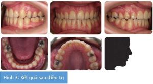 Phân tích case: Niềng răng thành công cho bệnh nhân nữ 22 tuổi than phiền về vẻ ngoài các răng trước