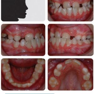 Phân tích case: Hình ảnh niềng răng thành công cho bệnh nhân 9 tuổi bị móm có bộ răng phức tạp