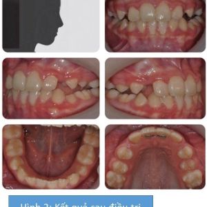 Phân tích case: Hình ảnh niềng răng thành công cho bệnh nhân 9 tuổi bị móm có bộ răng phức tạp