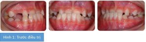 Phân tích case: Hình ảnh niềng răng cho bệnh nhân nữ bị móm, sai khớp cắn phức tạp