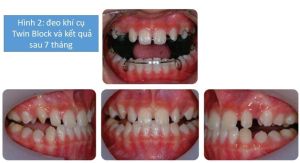 Phân tích case: Hình ảnh niềng răng cho bệnh nhân nữ bị móm, sai khớp cắn phức tạp