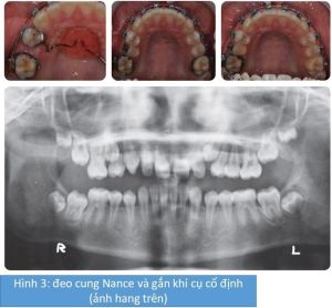 Phân tích case: Hình ảnh niềng răng cho bệnh nhân nữ bị móm, sai khớp cắn phức tạp