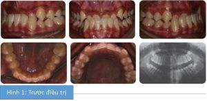 Phân tích case: Hình ảnh niềng răng thành công cho bệnh nhân nữ 15 tuổi bị móm