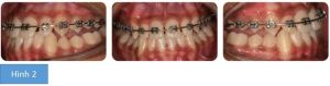 Phân tích case: Hình ảnh niềng răng thành công cho bệnh nhân nữ 15 tuổi bị móm