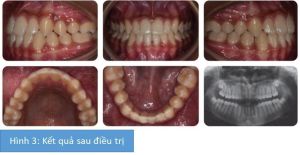 Phân tích case: Hình ảnh niềng răng thành công cho bệnh nhân nữ 15 tuổi bị móm