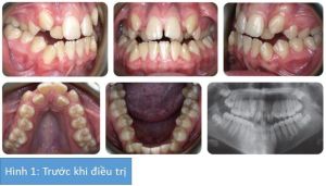 Phân tích case: Niềng răng kết hợp phẫu thuật hàm thành công cho nữ sinh viên 18 tuổi